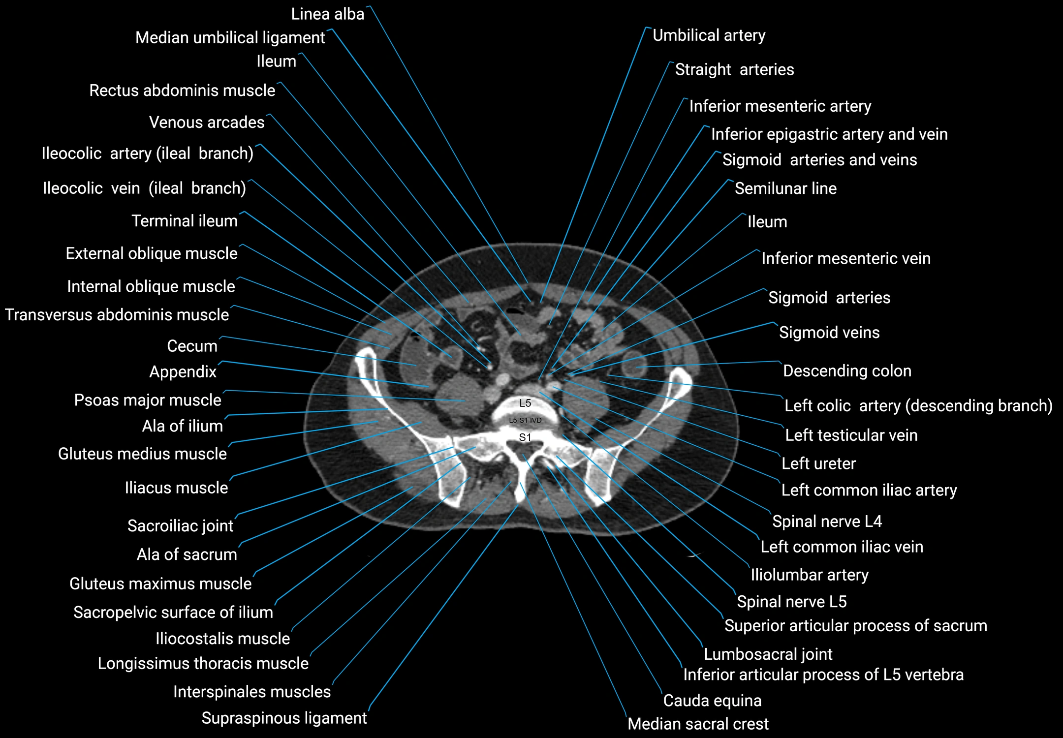 CT male pelvis axial cross sectional anatomy labelled radiology image -00134.webp